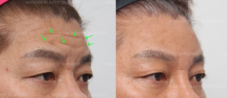이마 주름이 너무 깊어졌어요ㅠㅠ.내시경 이마거상과 이마 주름 필러(Filler)로 어떻게 좋아지는지 성형외과 전문의가 설명드립니다. 관련 이미지 6