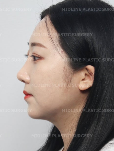 이중턱 지방흡입의 효과에 대하여 전문의가 알려드립니다. 관련 이미지 7