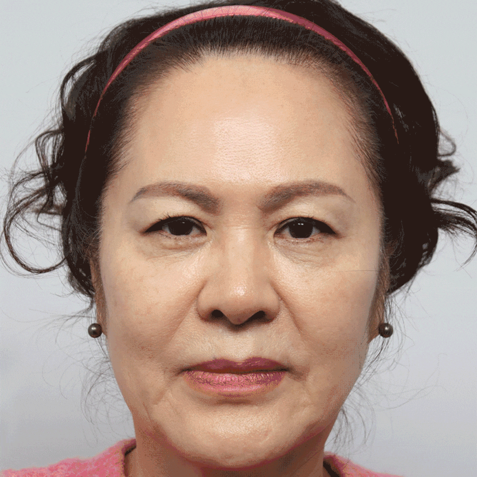 얼굴 주름 리프팅, 오래 지속되고 효과 좋은 수술방법은? 관련 이미지 18