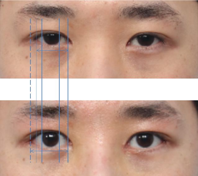 What Type of Plastic Surgery Is Needed for Small, Cramped Eyes? (About Lateral, Lower, and Combined Lateral-Lower Canthoplasty) image 9