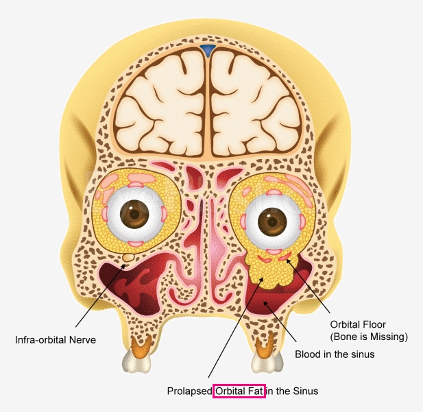 눈두덩이 꺼짐을 해결할 수 있는 눈꺼풀 지방이식! 성형외과 전문의가 설명드립니다. 관련 이미지 8