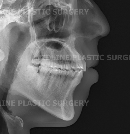 A Plastic Surgeon Explains the Changes in the Front and Side Views After Reduction Genioplasty and Advancement Genioplasty. (Feat. Rhinoplasty) image 8