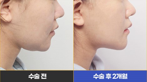 Fixing a Sagging Double Chin After Contouring Surgery! Let’s Learn About Mid-Up Lifting 2040. image 21