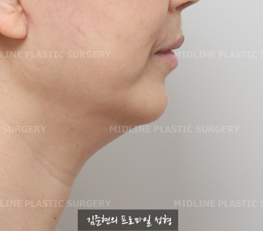 이중턱 근육 묶길 잘했어요^-^ 이중턱 근육묶기와 근육 밑 지방(포도송이 지방)제거까지 성형외과 전문의가 설명드립니다. 관련 이미지 1