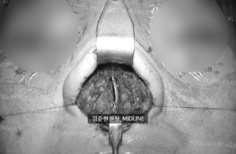 휜 코, 매부리 교정과 기능코-비중격만곡증까지 바로잡기 관련 이미지 18
