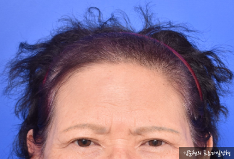 내시경 이마거상(Endoscopic forehead lift)에 대하여 성형외과 전문의가 알려드립니다. 관련 이미지 8