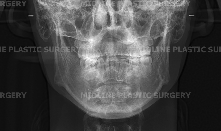 A Plastic Surgeon Explains the Changes in the Front and Side Views After Reduction Genioplasty and Advancement Genioplasty. (Feat. Rhinoplasty) image 7