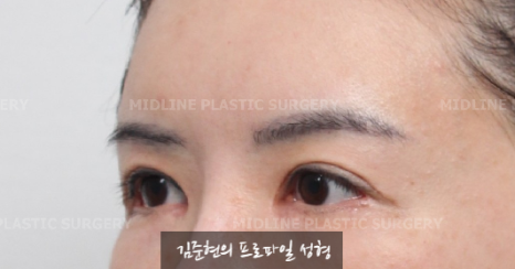 The outer corners of my eyes are open and my eyes stingㅠㅠI had lateral canthoplasty revision and eye corner restoration.(feat. Endoscopic forehead lift) image 11