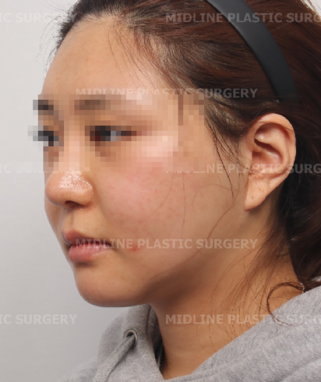 Fixing Sagging After Facial Contouring Surgery with a Face Lift!! (Feat. Plate Removal, Plate & Screw Removal) image 10