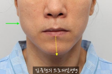 수술없이 간단하게 안면비대칭, 턱끝 비대칭(미드라인 맞추기) 해결하기!! 관련 이미지 5