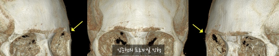 "아이홀뼈가 튀어나와서 보기 싫어요. " 아이홀뼈 절삭에 관하여 성형외과 전문의가 설명드립니다. 관련 이미지 6