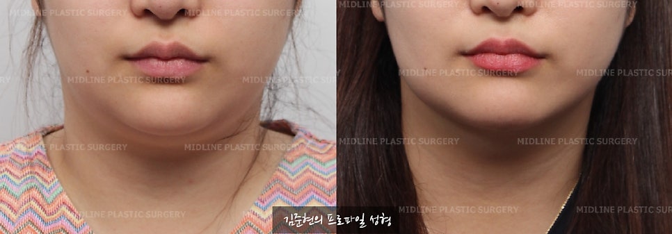이중턱이 고민이에요ㅠㅠ숨은 턱선을 찾아주는 이중턱, 턱라인 지방흡입! 미드업 2040에 관하여 설명드립니다. 관련 이미지 3