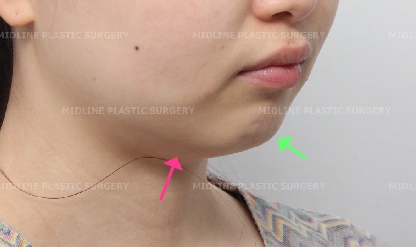 노마스크 시대를 대비한 턱끝전진술과 미드업2040으로 턱선만들기!! 관련 이미지 6
