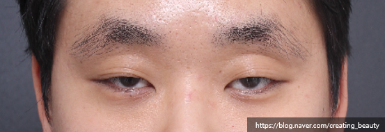 반드시 절개눈매교정으로 해야 하는 경우를 성형외과 전문의가 알려드립니다. 관련 이미지 4