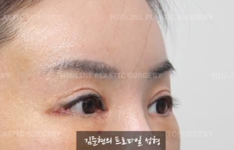 The outer corners of my eyes are open and my eyes stingㅠㅠI had lateral canthoplasty revision and eye corner restoration.(feat. Endoscopic forehead lift) image 10