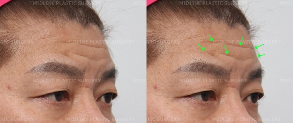 이마 주름이 너무 깊어졌어요ㅠㅠ.내시경 이마거상과 이마 주름 필러(Filler)로 어떻게 좋아지는지 성형외과 전문의가 설명드립니다. 관련 이미지 2