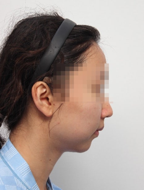 무턱 교정하면서 턱끝 비대칭(안면비대칭)까지 바로잡기! 관련 이미지 17