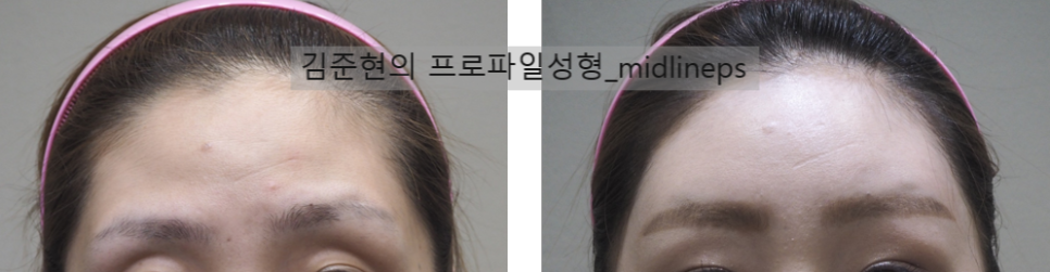 이마보형물. 권하지 않는 이유를 성형외과 전문의가 설명해 드립니다. 관련 이미지 5