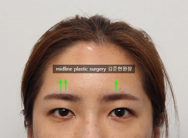 Forehead lift for people in their 20s and 30s: correcting eyelid sagging and even eye asymmetry! image 7