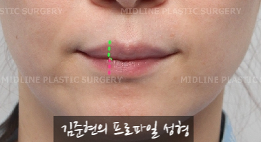 입술에 볼륨을 주는 방법은? 입술 지방이식에 관하여 관련 이미지 4