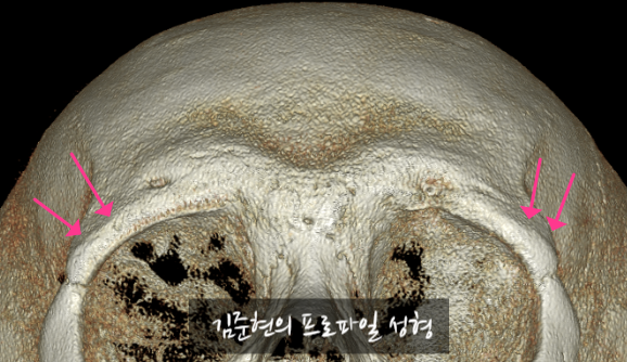 Let’s Learn About the Effects of Brow Bone Reduction Surgery. (Brow Bone? Eye Hole Bone? Here’s a Terminology Guide.) image 1