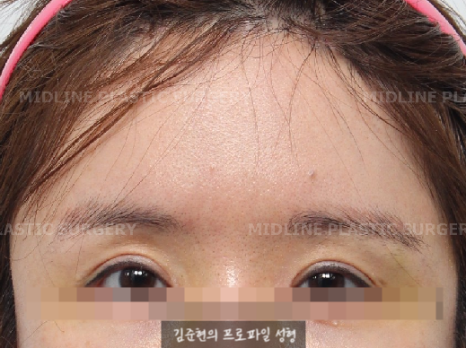 I want to go back to how it was before the forehead liftㅠ Is forehead lift reversal or release possible? image 4