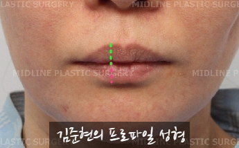 입술에 볼륨을 주는 방법은? 입술 지방이식에 관하여 관련 이미지 12