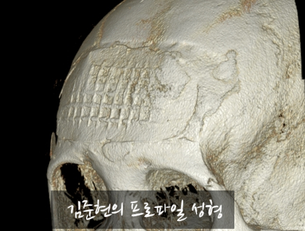 I Removed Two Forehead Implants. A Board-Certified Plastic Surgeon Explains Why I Do Not Recommend Forehead Implants. image 22
