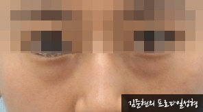 성형외과 전문의가 눈밑수술 케이스의 진단방법 및 나이들면 하는 수술이다라는 오해에 대해 설명해드립니다. 관련 이미지 5