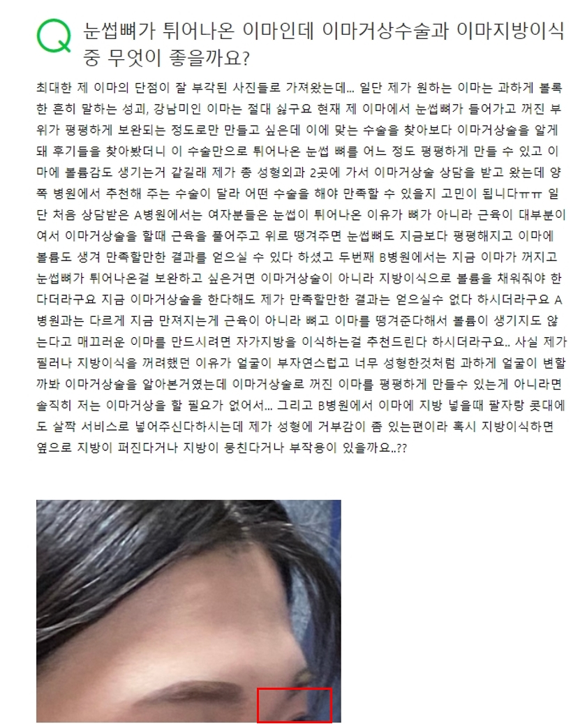 Forehead Lift for a Forehead with Prominent Brow Bones?? image 1