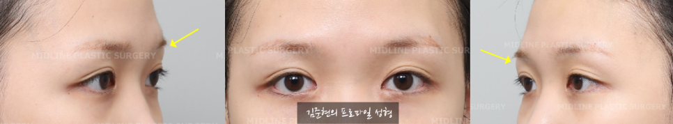 "아이홀뼈가 튀어나와서 보기 싫어요. " 아이홀뼈 절삭에 관하여 성형외과 전문의가 설명드립니다. 관련 이미지 7