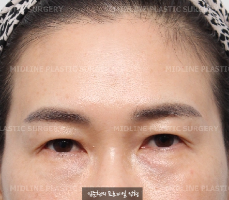 눈밑지방재배치 수술 전 눈밑 필러를 녹여야 하는 이유에 관하여 성형외과 전문의가 설명드립니다. (Feat. 이마거상) 관련 이미지 1