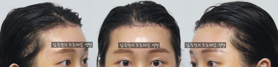 My Double Eyelids Are Hidden and I Want a Forehead Lift, But My Forehead Is Also Wide. What Should I Do? A Plastic Surgery Specialist Explains. (Forehead Lift + Forehead Reduction at the Same Time!) image 2