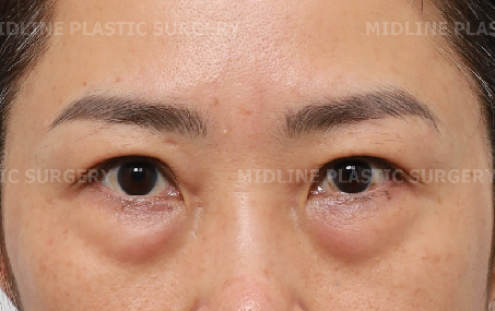 I don’t like bulging under-eye fat, dark circles, or wrinkles under the eyes. I’ll explain the no-touch lower blepharoplasty and fat grafting procedure. image 1