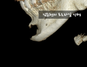 앞턱 보형물이 턱 옆으로 뚫고 나와요ㅠㅠ앞턱 보형물 제거 후 턱끝전진술을 한 케이스를 성형외과 전문의가 설명합니다. 관련 이미지 6