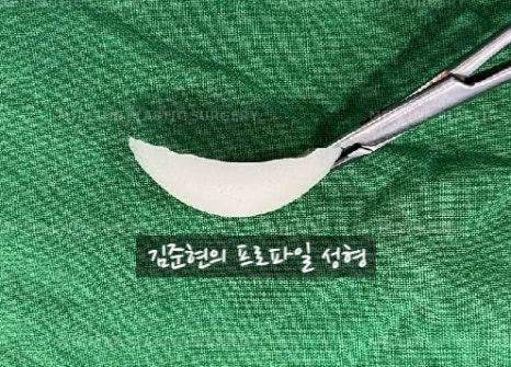 앞턱 보형물이 턱 옆으로 뚫고 나와요ㅠㅠ앞턱 보형물 제거 후 턱끝전진술을 한 케이스를 성형외과 전문의가 설명합니다. 관련 이미지 9