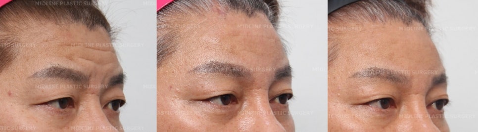 이마 주름이 너무 깊어졌어요ㅠㅠ.내시경 이마거상과 이마 주름 필러(Filler)로 어떻게 좋아지는지 성형외과 전문의가 설명드립니다. 관련 이미지 9