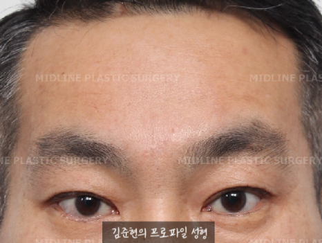 쌍꺼풀을 하려는데 이마주름이 심각해요....어떡하죠? 상남자의 자연스런 쌍꺼풀 만들기(Feat. 내시경 이마거상) 관련 이미지 7
