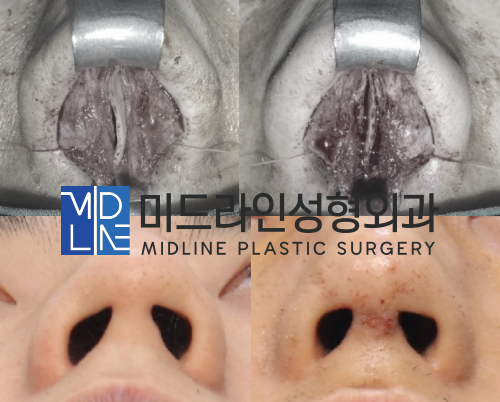The Plastic Surgery Specialist Explains Septoplasty, One of the Methods for Functional Nose Surgery for Rhinitis. (feat. Swing-door Technique) image 9