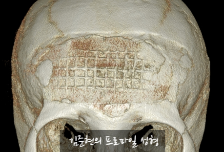 I Removed Two Forehead Implants. A Board-Certified Plastic Surgeon Explains Why I Do Not Recommend Forehead Implants. image 3