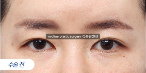 Forehead lift for people in their 20s and 30s: correcting eyelid sagging and even eye asymmetry! image 4