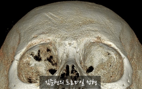 Let’s Learn About the Effects of Brow Bone Reduction Surgery. (Brow Bone? Eye Hole Bone? Here’s a Terminology Guide.) image 15