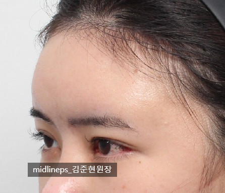 뒤트임 복원에 관하여 (Feat. 내시경 이마거상, 밑트임) 관련 이미지 5