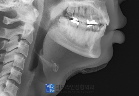 A Plastic Surgery Specialist Explains Why Chin Liposuction Is Sometimes Essential Because Jaw Reduction Surgery Alone Has Limited Effect image 8