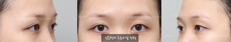 "아이홀뼈가 튀어나와서 보기 싫어요. " 아이홀뼈 절삭에 관하여 성형외과 전문의가 설명드립니다. 관련 이미지 3