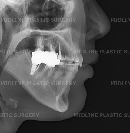 A Plastic Surgeon Explains the Changes in the Front and Side Views After Reduction Genioplasty and Advancement Genioplasty. (Feat. Rhinoplasty) image 3
