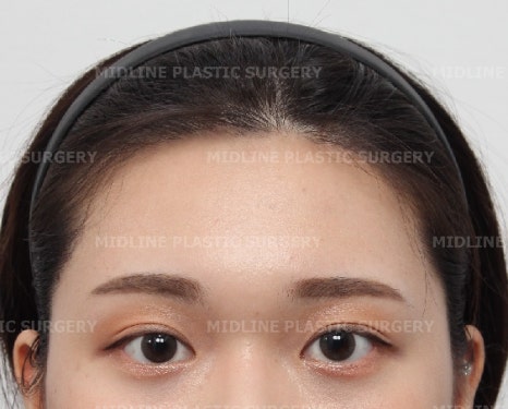 Forehead Lift for a Forehead with Prominent Brow Bones?? image 11