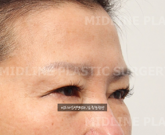 콧등 보톡스로 해결할 수 없는 콧등 가로주름!! 근본적인 해결에 대하여 알려드립니다. 관련 이미지 3