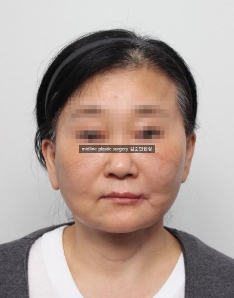 안면거상 흉터를 보여주는 곳은 없어서 미드라인성형외과가 보여드립니다. (feat. 심부볼리프팅) 관련 이미지 9