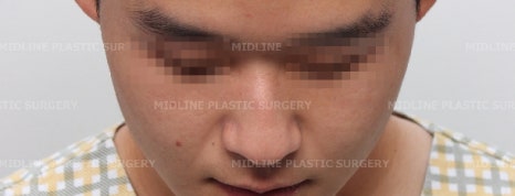 휜 코, 매부리 교정과 기능코-비중격만곡증까지 바로잡기 관련 이미지 24